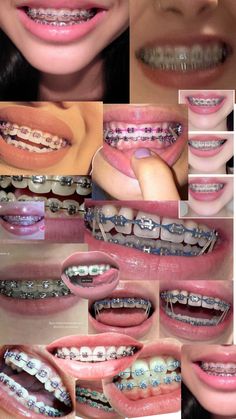 Head Gear Braces, Pink Braces Black Women, Braces Colors That Make Teeth Look White, Dark Red Braces, Aesthetic Braces Colors Ideas, Black Braces Teeth, Braces Color Combos, Braces Black Women