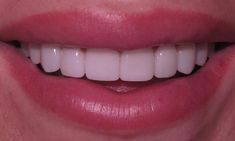 Straight Teeth Smile, Perfect Smile Aesthetic, Big Teeth Smile, Desired Teeth, Perfect Teeth Aesthetic, Veneers Before And After, Farmasi Aesthetic, Big Front Teeth, Teeth After Braces