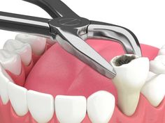 Otherwise known as caries or tooth decay, a cavity is a hole in the tooth. It is an opening on the hard surface of the tooth enamel that constantly expends unless it is treated. There are many reasons why cavities develop. Usually, it is a lack of dental hygiene. Dental Extraction, Tooth Pulled, Wisdom Tooth Extraction, Aesthetic Dentistry, Wisdom Teeth Removal, Tooth Removal, Teeth Implants, Tooth Extraction, Dental Procedures