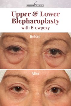 Belfaroplasty Eyes, Under Eye Surgery Before And After, Fibroblast Before And After Eyes, Eye Surgery Before And After, Eye Lid Surgery Before And After, Lower Blephoraplasty Before And After, Undereye Filler Before And After, Botox Under Eyes Before And After, Under Eye Filler Before And After