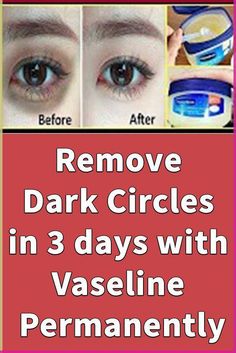 In this video I will share with you dark circles under eyes home remedy with Vaseline.  Apply Vaseline on your Under Eye Dark Circles and See the Magic, amaz... Vaseline Under Eyes, Remedies For Dark Circles, Moisturizing Eye Cream, Blackhead Remedies, Antiaging Skincare, Wrinkle Remedies, Concealer For Dark Circles, Remove Dark Circles, Under Eyes