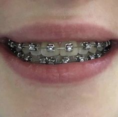 Grey Bracelet, Braces Girls, Brace Face, Braces Colors