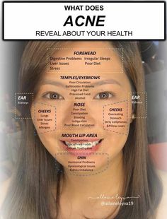 Face Mapping Acne, Clear Skin Face, Skin Advice, Face Mapping, Good Skin Tips, Acne Causes, Basic Skin Care Routine, Perfect Skin Care Routine