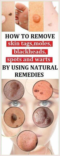 Amazing Advice-How To Get Rid Of  - Mole, Skin tags And Scars Naturally? by daor lemor | This newsletter was created with Smore, an online tool for creating beautiful newsletters for educators, businesses and more Remedies For Back Acne, Back Acne Remedies, Back Acne, What Is Health, Health Plus, Health Routine