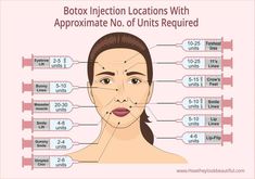 There’s no need to be ashamed of getting botoxafter alleven celebrities do itBut where on your face should you get a botox injectionHere’s a helpful guide with the approximate number of units injected per site. Botox Pre And Post Care, Diy Botox Injections, Best Botox Injection Sites, Botox Units Needed, After Botox Care, Botox Face Mapping, Cosmetic Injectables Aesthetic, Botox Brow Lift Injection Site