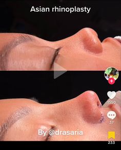 Nose Manifestation, Asian Nose, Dream Nose, Desired Face