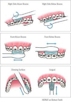 Health Treats, Braces Ideas, Teeth With Braces, Hygiene Hacks, Cute Braces Colors, Kids Braces, Braces Tips, Getting Braces, Kedokteran Gigi