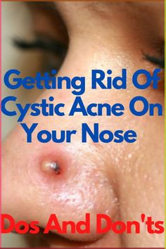 How Do You Get Rid Acne On Nose, Cystic Acne Remedies, Nose Picking, Skin And Hair Clinic, Nose Cleaner, Natural Acne Remedies