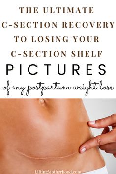 C Section Shelf Workout, C Section Shelf, Cesarean Recovery, Pregnancy Remedies, C Section Scar, Post C Section, Postpartum Care Kit