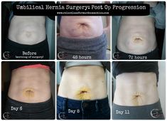 Umbilical hernia surgery recovery suggestions based upon my first hand experience, and things I wish I had known prior to surgery. Diastasis Recti, Surgery Recovery, Post Op, Post Surgery, After Surgery, Keeping Healthy, Abdominal Muscles, Body Health, Losing Weight