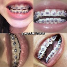 Cute Color Braces Ideas, Braces Cute Colors, Braces Colors Lavender, Purple Braces Aesthetic, Teeth Braces Colors, Brace Aesthetics, Braces Colors Purple, Braces Inspo Colors, Braces Colour Ideas