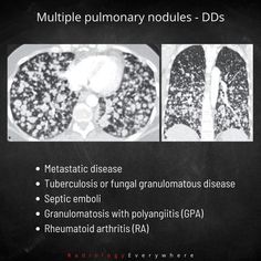 Differential Diagnoses in Radiology | Radiology Everywhere For Everyone