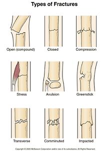 the different types of fractured bones and their corresponding structures are shown in this diagram, which shows