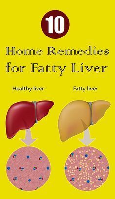 Top 10 Home Remedies for Fatty Liver Top 10 Home Remedies, Detox Your Liver, Detox Diet Plan, Diy Remedies, Liver Detox, Healthy Liver, Natural Therapy, Liver Health, Body Detox