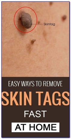 Remove Skin Tags, Remove Skin Tags Naturally, Tag Remover, Get Rid Of Warts, Home Remedy For Cough, Skin Tags, Cold Sores Remedies, Natural Health Care, Natural Sleep Remedies