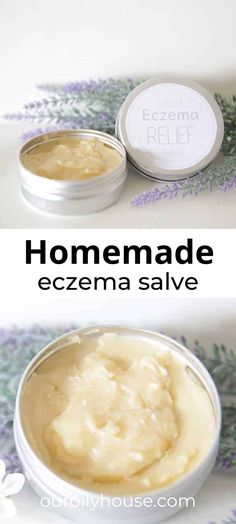 Coconut Oil For Excema, Homemade Excema Remedy, Homemade Excema Cream, Diy Excema Relief, Soap For Excema Sensitive Skin, Natural Remedy For Excema, What Helps Excema, How To Treat Excema, Natural Itch Relief Skin