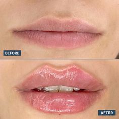 Lip Flip Result in Istanbul Lip Fillers Before And After, Lip Flip, Aesthetic Center, Surgical Procedures, Lip Augmentation, Lip Filler, Lip Enhancement