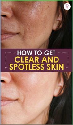 How To Get Clear And Spotless Skin: While you need to fix these things to get your skin feeling healthy, there are also a few home remedies that can help you get your natural glow and radiance back! Read on to try a few for yourself and see the difference. How To Get Clear Face Naturally, How To Help Breakouts Clear Skin, Smoother Face Skin Care, How To Get Clear Even Tone Skin, Improve Skin Texture Naturally, How To Get Spotless Clear Skin, How To Clean Skin, Secret To Clear Skin, How To Clean Face Clear Skin