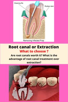 When people with dental infection consult a dentist he or she may suggest RCT or extraction depending on the condition of the tooth. Is it better to get a root canal or extraction? This question arises in most of our minds. Most of the people don’t know what is the difference between root canal treatment and extraction. We need to be familiar with the terms root canal and extraction. #dental #oral heygiene #dentalhealth #dental #dentalcare #dentalhygienist #toothcare #rootcanal #toothextraction Dental Infection, Dental Extraction, Tooth Decay Remedies, Tooth Care, Kid Experiments