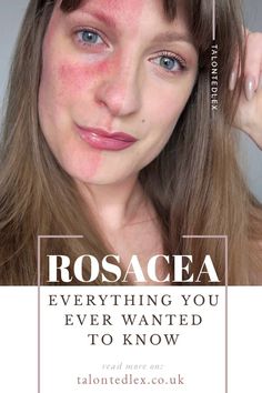 Discover everything you ever wanted to know about rosacea - written by someone with rosacea! Looking for rosacea tips? Skincare routine advice? Make up for rosacea? Rosacea treatments? This is the blog post for you. #talontedlex #rosacea #rosaceatips Pinterest Creator, Beauty Boss, Chemical Sunscreen, Tips Skincare, Skin Care Solutions, Skin Care Regimen, Anti Aging Skin Care