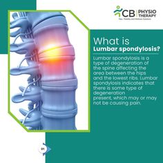 Lumbar Spondylosis Physio Tips, Lumbar Spondylosis, Human Biology, Lumbar Pain, Lumbar Spine, Medical Posters, Feminine Health, Medical Anatomy, Health Facts