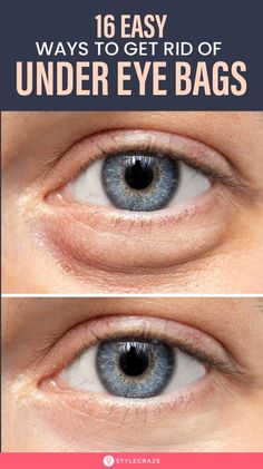 Undereye Bags Remedy, Get Rid Of Eye Bags, Rid Of Eye Bags, Lifting Facial, Dark Circles Under Eyes