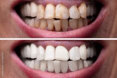 Get Whiter Teeth, Plaque Removal, Yellow Teeth, Good Birthday Presents, Stained Teeth, White Teeth, Mouthwash, Teeth Cleaning