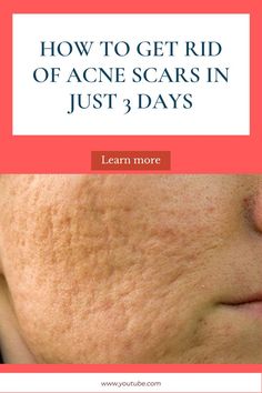 How to get rid of acne scars in a week Marks On Face, Honey Turmeric, Remedies For Acne, Get Rid Of Acne, Rid Of Acne, Home Remedies For Acne, Turmeric Powder, Milk Honey, Acne Remedies