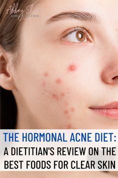 We look at the research on the hormonal acne diet and break down the evidence on the best and worst foods for healthy clear skin. Detox Water For Clear Skin, Hormonal Acne Diet, Healthy Clear Skin, Food For Acne, Acne Causing Foods, Foods For Clear Skin, Clear Skin Routine, Clear Skin Diet, Acne Diet