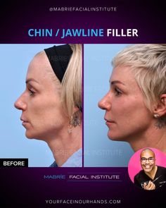 a woman's profile before and after rhinoplast surgery with chin / jawline filler