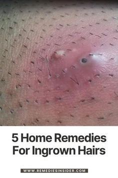 Hair Exfoliation, Skincare Blackheads, Treat Ingrown Hair, Best Foods For Skin, Ingrown Hair Remedies, Fresh Aloe Vera Gel, Pimples On Face, Natural Toner, Fresh Aloe Vera