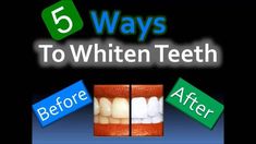 58K views · 777 reactions | Teeth Whitening and Scaling at Home You Will Get Pearl White Teeth #teethwhitening #teething #teethcleaning #diy #homemade #reels #reelsfb Anmol Hindi | Anmol Hindi | AirLands · I Give You My Lungs Teeth Whitening Remedies, Beauty Organization