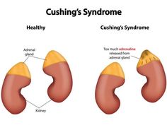 Cushing’s Syndrome, Cushings Disease, Low Thyroid Remedies, Thyroid Remedies, Cushings Syndrome, Adrenal Glands, Adrenal Fatigue, Endocrine System