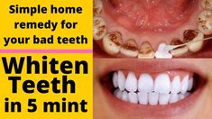 How to Make Teeth Whiter in Adults & Kids: 7 Natural Tips Home Teeth Whitening Diy, Skin Care Home Remedies, Bad Teeth