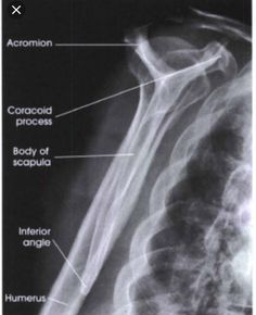 an x - ray image shows the location of the shoulder and its major structures, including ribs