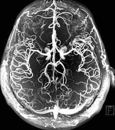 an x - ray image of the inside of a human brain