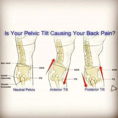 Posterior Pelvic Tilt, Anterior Pelvic Tilt, Physiotherapy Exercises, Pelvic Tilt, Guided Imagery, Body Condition