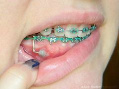 Invisible Teeth Braces, Natural Teeth Whitening Diy, Braces Bands, Kids Braces, Braces Girls, Invisible Braces