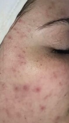 Before After Skincare, Closed Comedones, Before And After Acne, Acne Scar Remedies, Deco Spa, Skincare Routine Acne, Skin Blackheads, Scar Remedies, Facial Diy