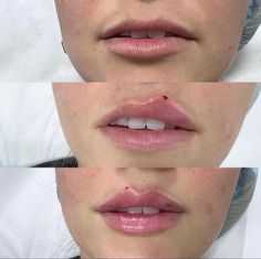 Lip Filler Russian, Russian Lip Filler Technique, Russian Lips Filler, Lip Filler Before And After, Lip Filler Technique, Russian Lip Filler, Face Plastic Surgery, Russian Lips