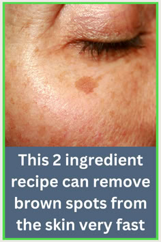 Lighten dark spots naturally with lemon juice, aloe vera, or products containing licorice extract or vitamin C, and use sunscreen for protection #skin #sunspots #lighterskin #darkspots Darkspots Skincare, Natural Face Skin Care, Skin Care Quiz, Skin Care Wrinkles, Lighten Dark Spots, Spots On Face, Kakadu Plum, Lighter Skin, Brown Spots