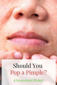 Should You Pop Pimples, How To Pop A Pimple Under The Skin, Natural Remedies For Acne, Popping Pimples, Sunburn Peeling, Remedies For Acne, Human Body Temperature