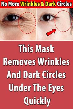 This Mask Removes Wrinkles And Dark Circles Under The Eyes Quickly. The area around the eyes is prone to wrinkles. And if you are looking for a way to get ri... Wrinkle Remover, Dark Circles, Circles, Mask