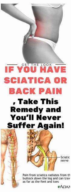 8-Successful-Treatments-For-Pain-C Vic Vaporub, Sciatica Symptoms, Sciatica Exercises, Sciatica Pain Relief, Sciatica Relief, Back Pain Remedies, Nerve Pain Relief, Sciatic Nerve Pain, Sciatica Pain