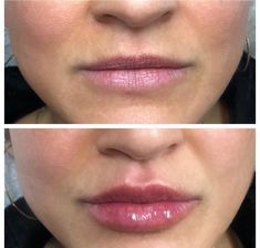 Lip Fillers Juvederm, Lip Job, Face Plastic Surgery, Facial Procedure, Facial Surgery