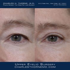 Before and after upper eyelid surgery by Dr. Thorne https://charlesthornemd.com/face-surgery/ - - #cosmeticsurgery #plasticsurgery #facelift #beforeandafter #plasticsurgeon #beauty #nyc #bestplasticsurgeon #newyork #surgery #transformation #blepharoplasty #doctor #boardcertifiedplasticsurgeon #eyes #eyelidsurgery #realpatients #cosmeticsurgeon #realresults #topplasticsurgeon #charlesthornemd #eyelids Dr Thorne