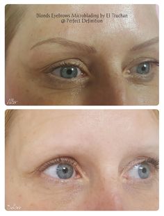 Slim Eyebrows, Plasma Fibroblast, Eyebrows Microblading