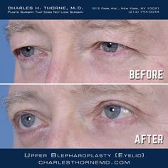 Before and after upper eyelid surgery (blepharoplasty) by Dr. Thorne.- https://charlesthornemd.com/face-surgery/blepharoplasty-eyelid-surgery.html - - #cosmeticsurgery #plasticsurgery #facelift #beforeandafter #plasticsurgeon #beauty #nyc #bestplasticsurgeon #newyork #facelift #surgery #beauty #chinimplant #transformation #beforeandafter #bestplasticsurgeon #blepharoplasty #doctor #necklift #boardcertifiedplasticsurgeon #eyes #eyelidsurgery Plastic Surgery Recovery, Cheek Implants