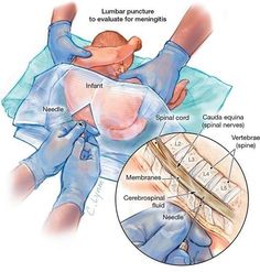 an illustration shows the location of lumba pressure to alleviate for meningis