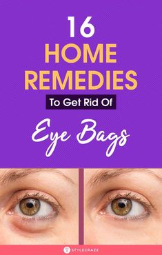 Bags under your eyes may develop due to illness, fatigue, or aging. Want to know how to get rid of eye bags? These are the 16 most effective ways to do it. How To Help Puffy Under Eyes, Tired Eyes Remedy, Get Rid Of Eye Bags, Rid Of Eye Bags, Eye Bag Remedies